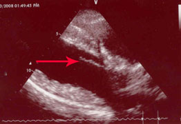 Indy's Mitral Valve